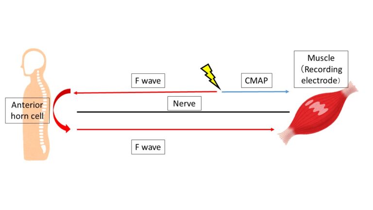 EMG Basics Part 2 : Interpretation Of Nerve Conduction Test Results ...